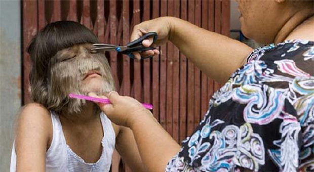  Thỉnh thoảng, Supatra Sasuphan cũng phải tỉa bớt lông trên mặt để bớt đi phần rậm rạp bởi chúng mọc quá nhanh. (Ảnh: Dailynews)