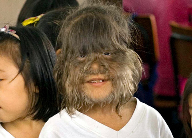  Cô bé từng nổi tiếng là người có nhiều lông nhất thế giới 2010. (Ảnh: Dailynews)