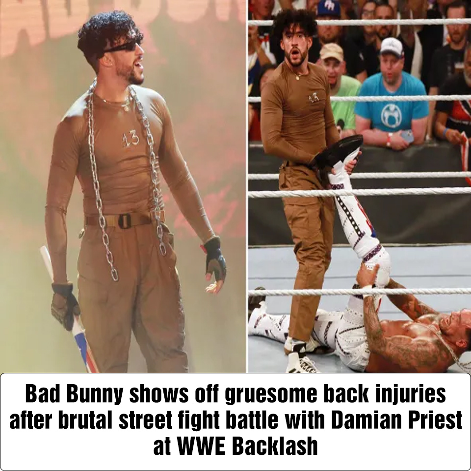 Bad Bunny Shows Off Gruesome Back Injuries After Brutal Street Fight Battle With Damian Priest 